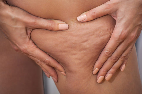 What Causes Cellulite and How to Reduce It
